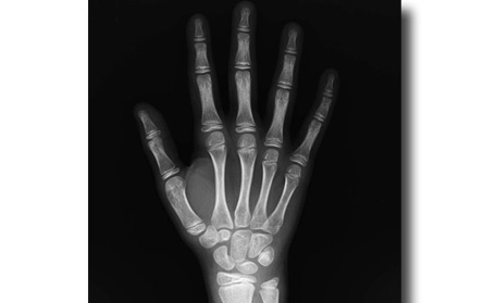 carpal