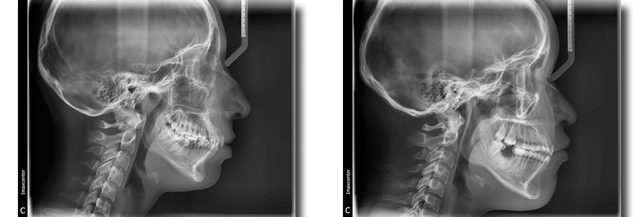 Radiografia de maxilar y mandibula